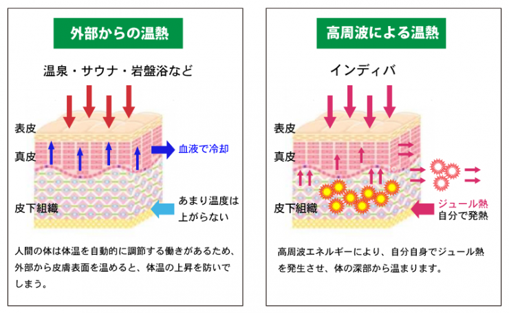 インディバ温熱療法