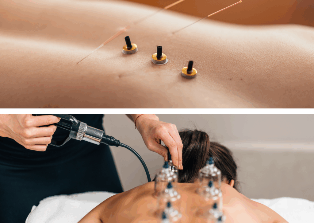 鍼灸×カッピング療法の施術模様